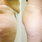 cellulite before and after3 (2022_03_27 20_50_32 UTC)